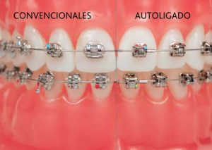 TIPOS DE BRACKETS Cl nica Dental Fabi n L pez