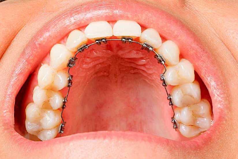 TIPOS DE BRACKETS Clínica Dental Fabián López