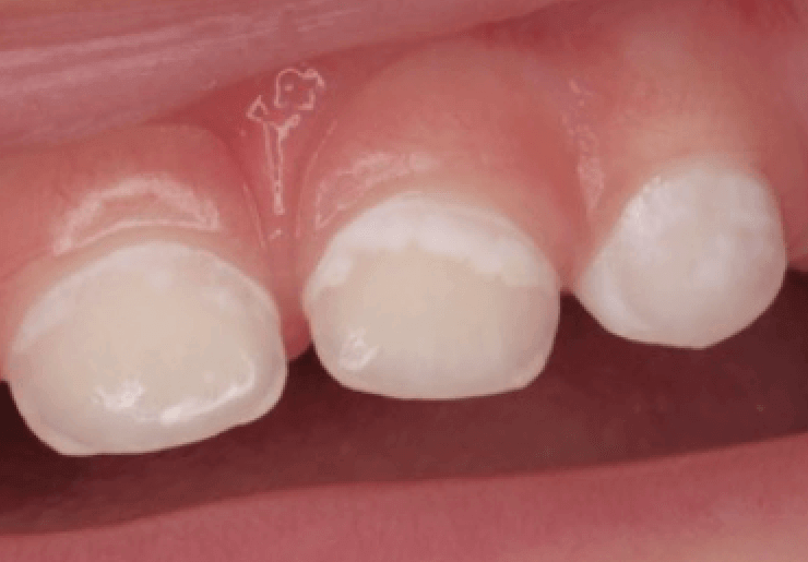 MI HIJO TIENE CARIES, ¿QUÉ HAGO? - Clinica Dental Fabián López para Ibi