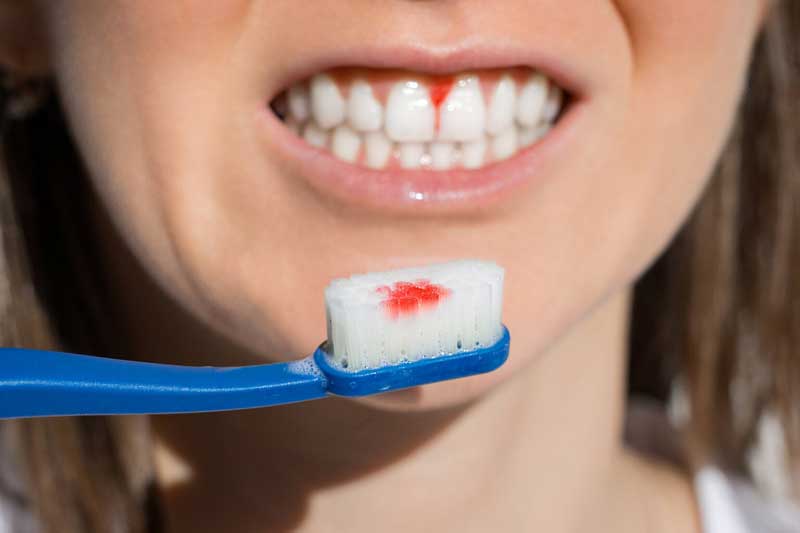 sangrado cepillar dientes